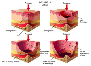 Decubitus ulcer clipart