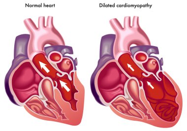 Dilated cardiomyopathy clipart