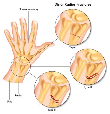 Distal radyus kırıklar