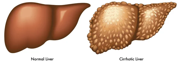 Cirrhosis — Stock Vector