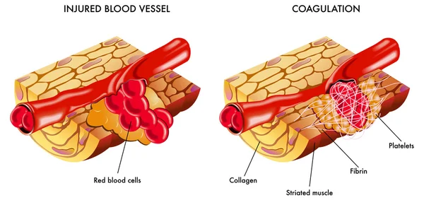 Coagulazione del sangue — Vettoriale Stock