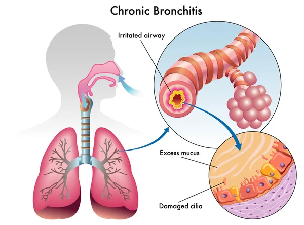 Bronquite crónica — Vetor de Stock