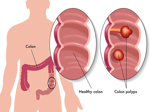 Pólipo de colon — Vector de stock