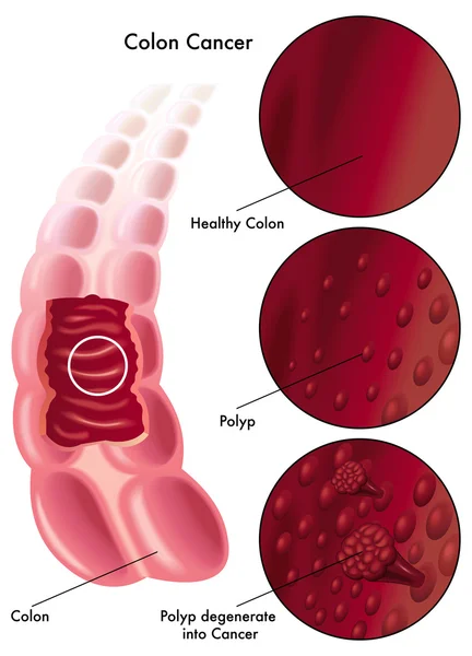 Cáncer de colon — Vector de stock