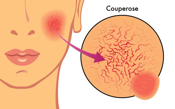 Couperose — 스톡 벡터