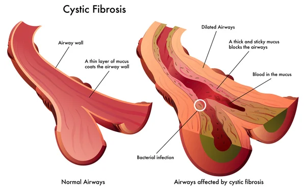 Cystic Fibrosis — Stock Vector