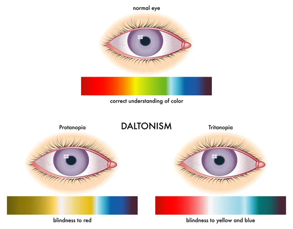 Daltonismo — Vettoriale Stock