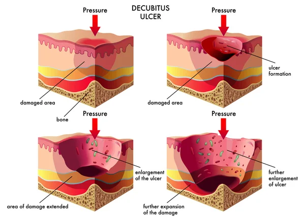 Decubitus Ülseri — Stok Vektör