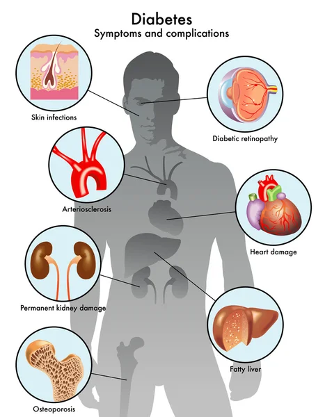 Diabetes — Vector de stock