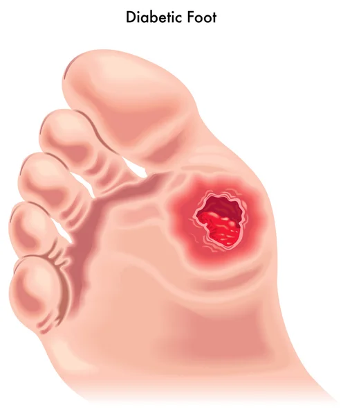 Diabetische voet. — Stockvector