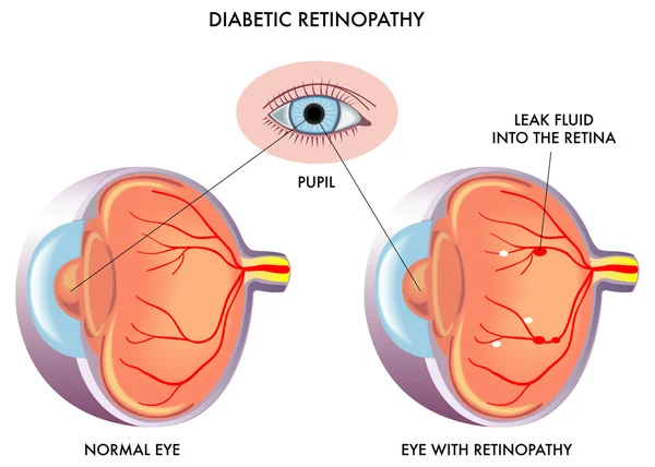 Retinopatia diabética —  Vetores de Stock