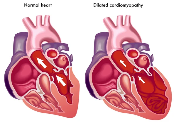 Cardiomiopatia dilatata — Vettoriale Stock