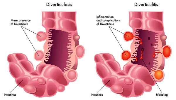 Diverticulosi & Diverticolite — Vettoriale Stock