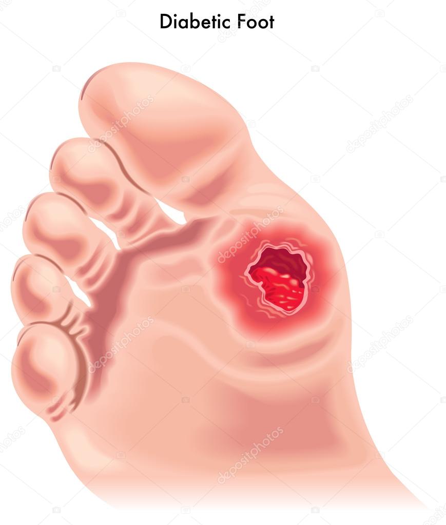 neuropathia láb diabetes kezelésére