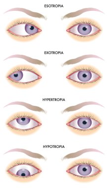 Strabismus clipart