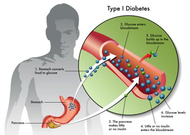 Type 1 Diabetes Labeled clipart