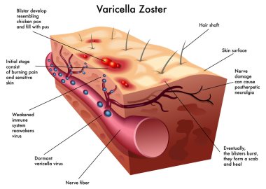 Varicella zoster clipart