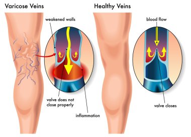 miometric varicoseza tratamentul scleroterapiei varicoase