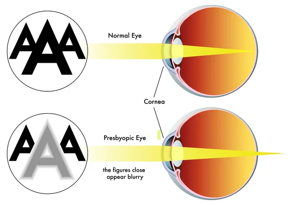 Presbyopia — Stockový vektor