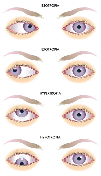 Strabismus — Stock Vector