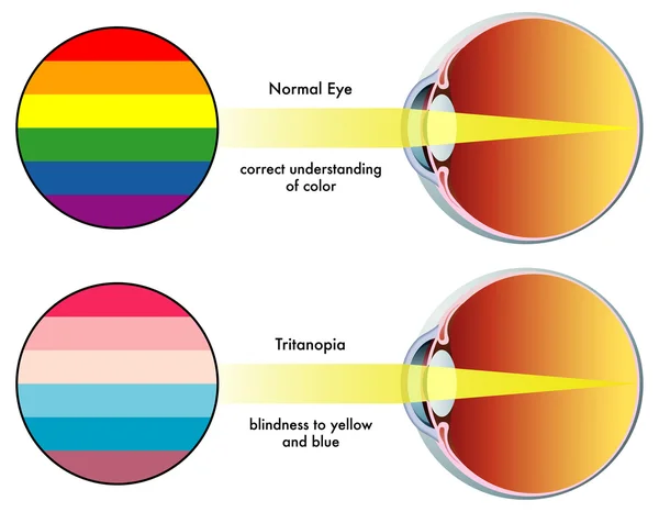 Tritanopie — Stockvektor