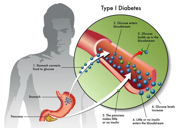 Diabetes tipo 1 etiquetada — Vector de stock