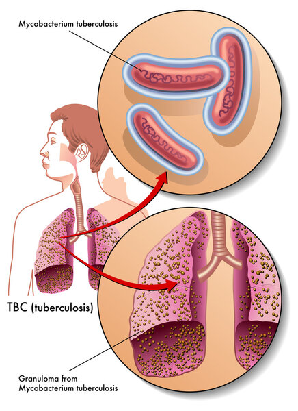 Туберкулез
