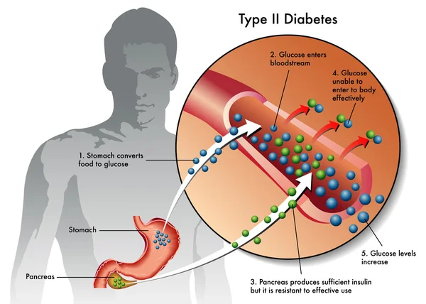 Arten von Diabetes. — Stockvektor