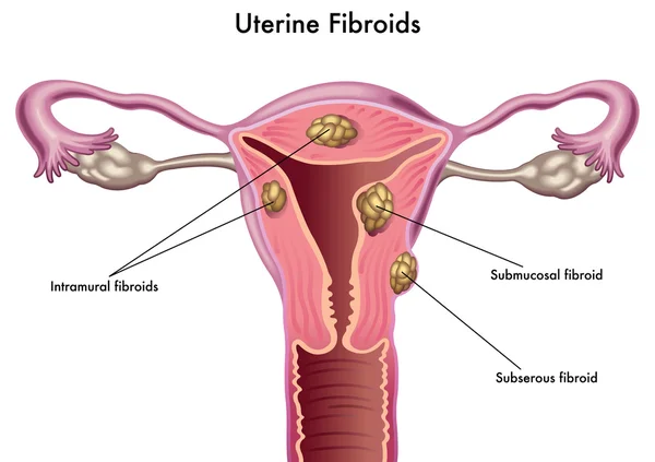 Fibromas uterinos — Vector de stock