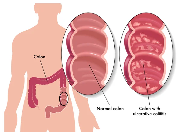 Colitis ulcerosa — Archivo Imágenes Vectoriales