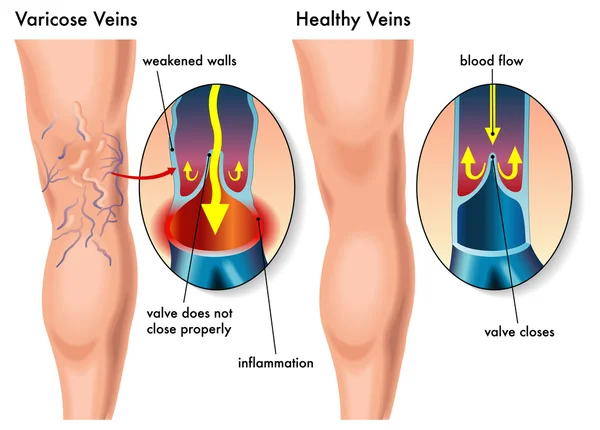 Veias varicosas — Vetor de Stock