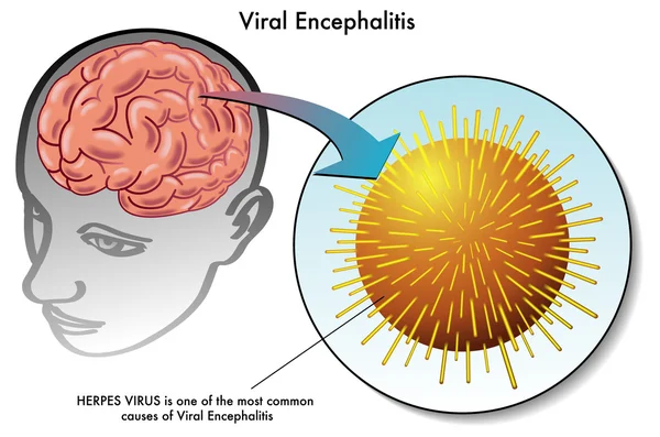 Encefalite viral —  Vetores de Stock