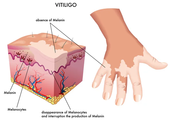 Vitiligo — Stockvector