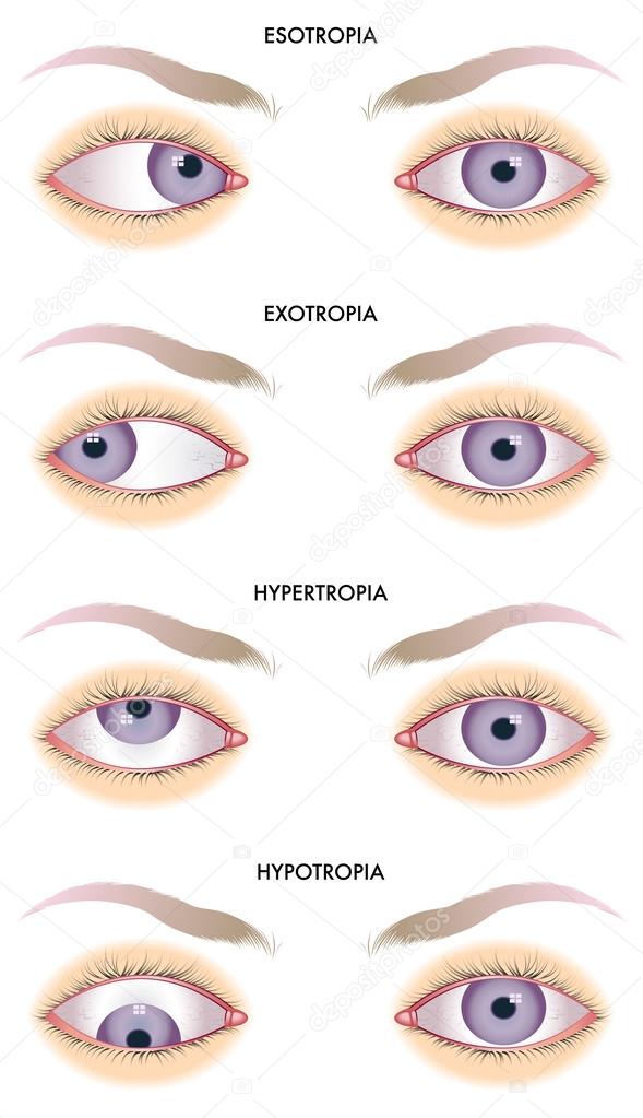 Strabismus