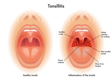 Detailed human Tonsillitis clipart