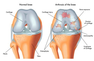 Human Arthrosis of knee clipart