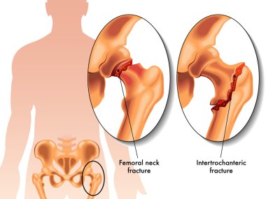 İnsan femur kırığı
