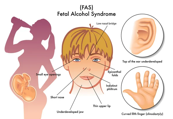 Fetal alkol sendromu. — Stok Vektör