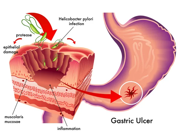 Úlcera gástrica humana — Vector de stock