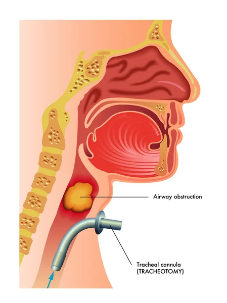 Detaljerad mänskliga trakeotomi — Stock vektor
