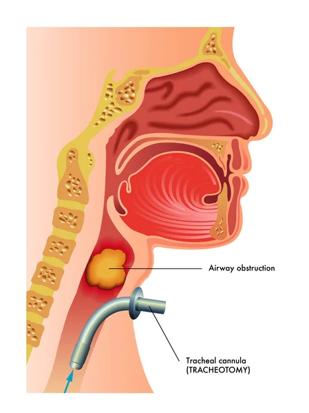 Podrobné lidské tracheotomie — Stockový vektor