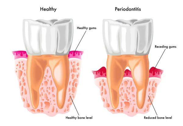 Periodontite humana detalhada — Vetor de Stock