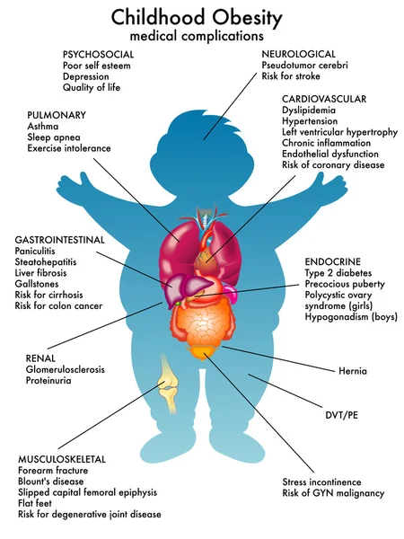 Obesidad infantil detallada — Archivo Imágenes Vectoriales