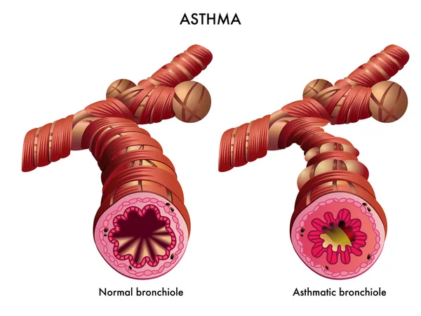 Medizinische Auswirkungen von Asthma — Stockvektor