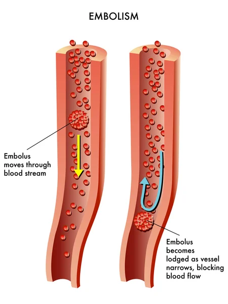 Detailed human Embolism — Stock Vector