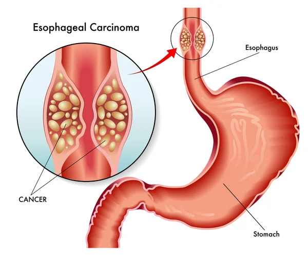 Mänskliga esofagus cancer — Stock vektor