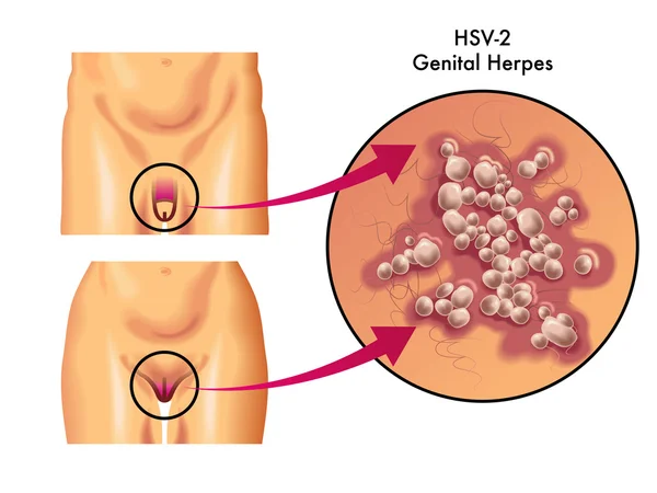 Human Genital herpes — Stock Vector