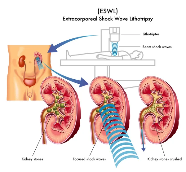 Litotricia extracorpórea por ondas de choque — Vector de stock