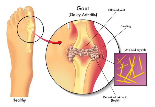 Detailed human Gout — Stock Vector