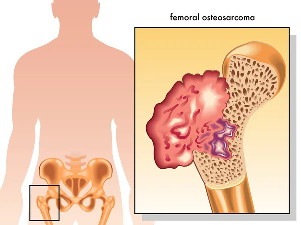 Osteosarcoma femoral humano — Archivo Imágenes Vectoriales